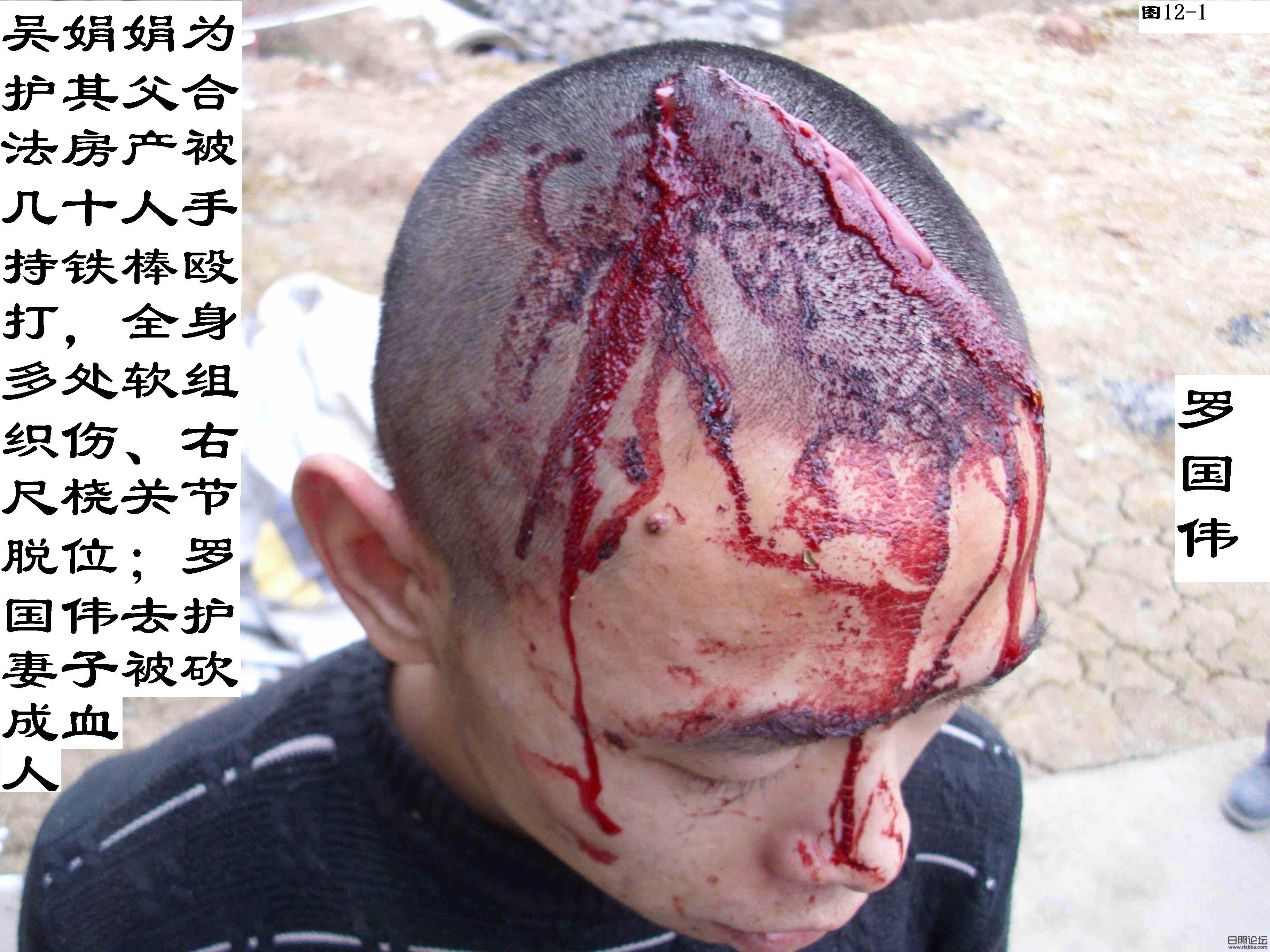 12-1 罗国伟去护妻子被砍血人一个.jpg